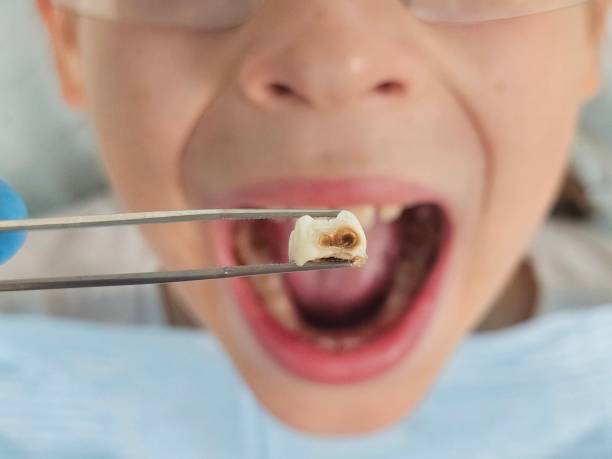 Best Emergency Dental Extractions in New Windsor, MD