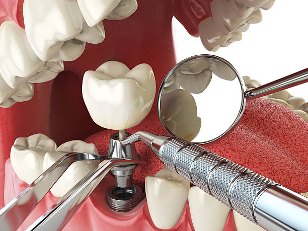 Best Emergency Dentist for Knocked-Out Tooth in New Windsor, MD